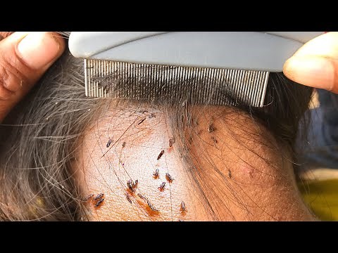 Removing Thousand of Lice From Head Using Comb And Taking All Lice out of Long Hair ##03