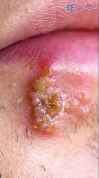 What is Herpes Labialis? | What is the reason for Herpes Labialis? | Dr. Rohit Batra Explains