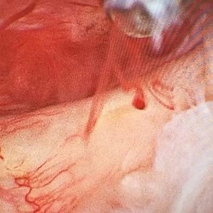 Observamos una visión artroscopica en posición silla de playa de una lesión parcial del subescapular #artroscopia #hombro #shoulder #cirugiadehombro #shouldersurgery #lesionsubescapular #subscapularistear #rotatorcuff #manguitorotador #sportsmedicine #medicinadeldeporte | Dr Adrian N. Sirio