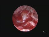 Cholesteatoma Ear Endoscopic Surgery • Video • MEDtube.net