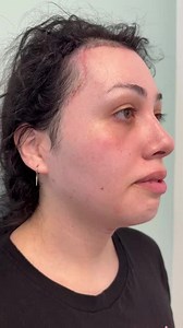 2 Week After Facial Feminization Surgery