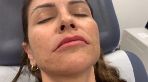 Lip filler treatment using Restylane Kysse, the newest FDA approved lip filler by Dr. Shaun Patel in Miami, FL