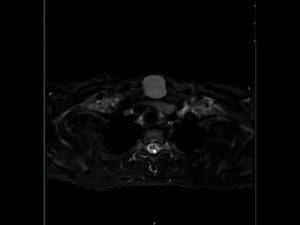 Dermoid, Soft Tissues Neck