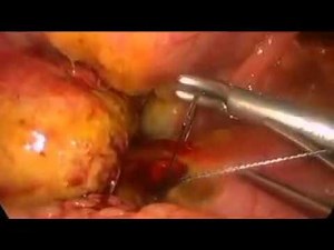 Laparoscopic Repair of a Perforated Duodenal Ulcer in a Child's Class C Cirrhotic Patient • Video • MEDtube.net