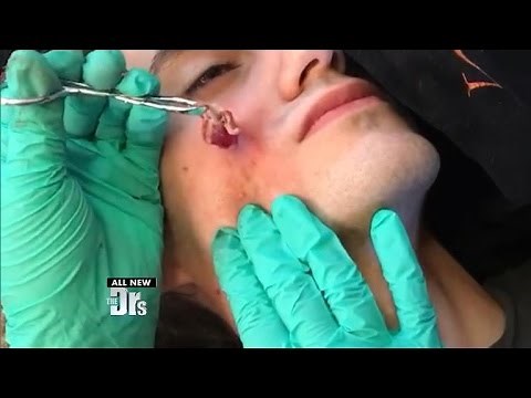 Cyst Excision: Don’t Try This At Home! | The Doctors
