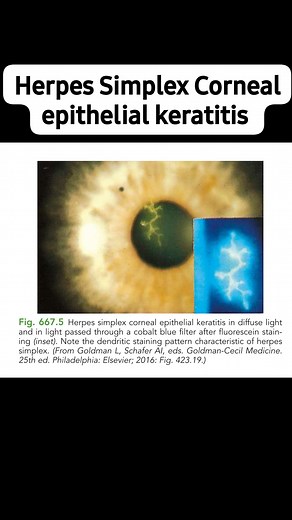 #herpessimplexvirus #keratitis #ophthalmology #pediatrics #MCQ #IMAGE #NEETPG #NEETSS #inicet | A Paediatric Mind