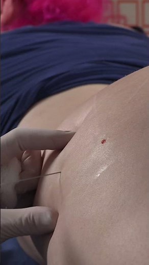 I Tried Sculptra Injections for My Brazilian Butt Lift and Got SHOCKING Results