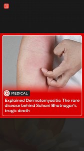 Explained Dermatomyositis: The rare disease behind Suhani Bhatnagar's tragic death. #dermatomyositis #treatments #symptoms #disease #stayinformed #inshorts | Inshorts