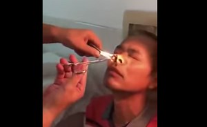 Watch: Doctor removes blood-sucking leech from man's nostril