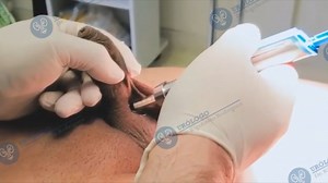 Circuncisión - Dr Rigoberto Rodríguez