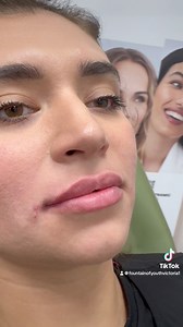 RHA fillers 😱😍💋💋 #FountainOfYouthMedSpa #rninjector #VictoriaTX #lipfiller #RHA | Fountain of Youth Medical Spa