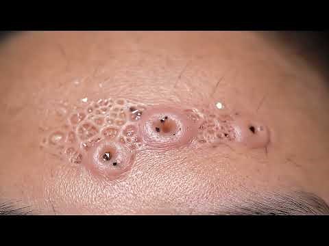 EXTREMELY Satisfying: Deep Blackhead Removal! 🤩 Watch Pores Instantly Clear