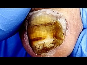 A Whole Piece Of Onychomycosis, Completely Cut Off【Podiatry Clinic】