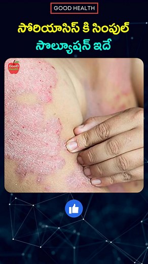 Psoriasis Home Remedies - Dr Manthena Satyanarayana Raju #Skin #Psoriasis #GoodHealth #DrManthenaSatyanarayanaRaju | Good Health