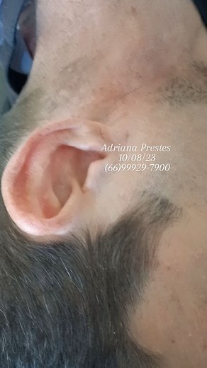 Que tudooooo... quem curtiu🙋🏾‍♀️🙋🏾‍♂️🙆🏽🙆🏼‍♀️ Deixa seu comentário 👇🏾 Queixa principal era zumbidos no conduto auditivo. Vc sabia que na maioria das vezes o Zumbido é causado por excesso de cerume? Dúvidas? Me chama no WhatsApp (66)99929-7900 #zumbido #excessodecera #indolor #dordeouvido #ouvido #ouvidointupido #conehindu #conehindu #sinopmatogrosso #sinopmt🌵 #sinopmt #sinopmilgrau #sinop #lavemsinop #noticias #satisfatório #emprrendedorismo #empreendorismofeminino #satisfação #videos 