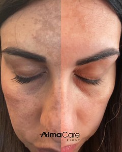 1.1K views · 13 reactions | Rimuovi macchie e melasma ✨ Il risultato...