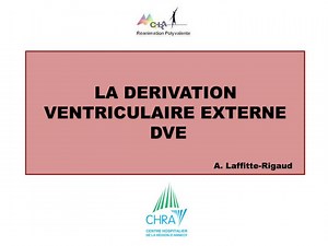 LA DERIVATION VENTRICULAIRE EXTERNE DVE - SlideServe