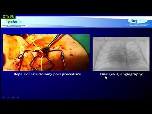 PDA stenting in PA/VSD