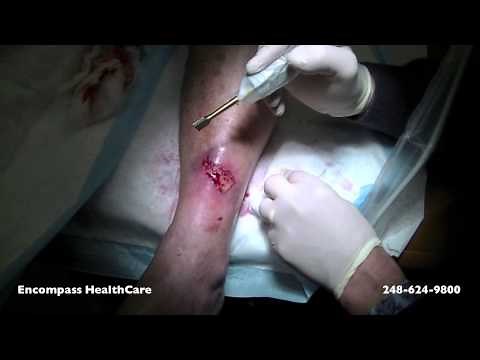 Wound Care Debridement Video.mov
