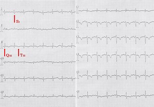 Empyema Treatment: Saline Irrigation via Tube Thoracostomy – Archyde