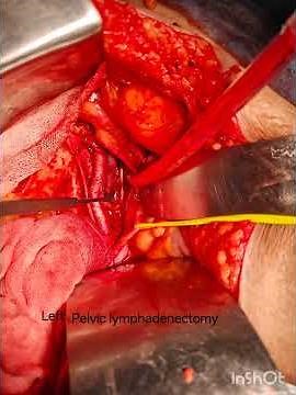 Staging laparotomy for large ovarian borderline tumour