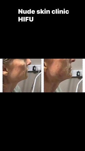I can taylor make a HIFU facial for you. I’m now confident to tweek further than your bog standard jaw snatch & neck tightening, eye bags and crows feet. There’s no needles involved at all, no down time. Consultations over wats app or face to face for £10 to be taken off treatment price go to my page Nude Skin Clinic text 07875015872 available at Dollicious HQ or Blush Beauty - 110 Barnsley road, Wath prices start from £120 on the face #nonsurgicalfacelift #lunchtimefacelift | Stephanie Lynne
