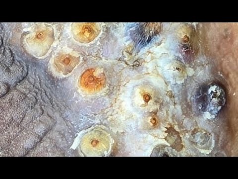 David's Jigger Removal 2024 Preview #2