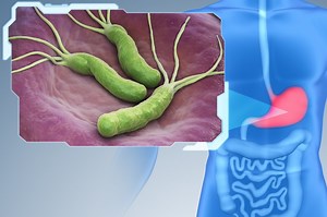 Helicobacter Pylori infection: what are the symptoms?