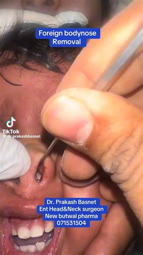 Foreign bodynose Romoval