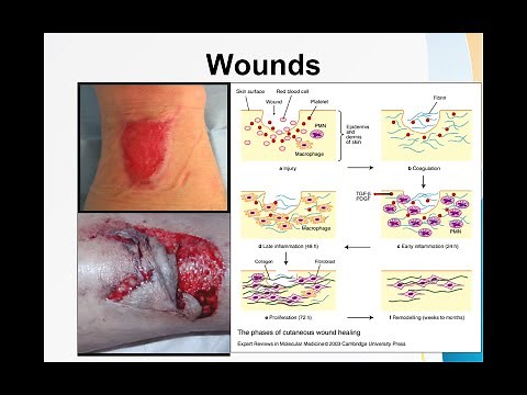 Wounds