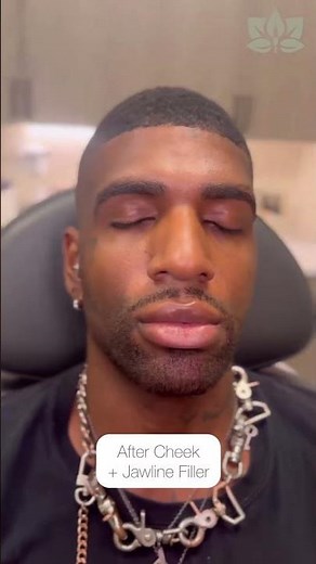 Before + After: Cheek + Jawline Filler