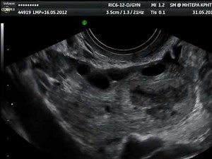 Corpus Luteum on Transvaginal Ultrasound • Video • MEDtube.net