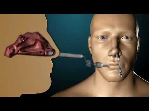 ArthroCare ENT- Rapid Rhino® Product Family Inservice.mp4