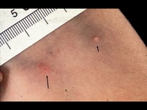 Pathergy Phenomenon; exaggerated skin reaction to minor trauma, such as a needle prick or scratch