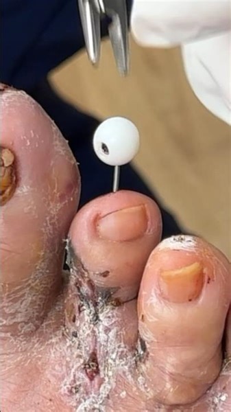 Does it hurt to have pins removed from toes? #shorts