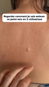 Zoom sur un point noir bien incrusté. Objectif : l’enlever en 2 utilisations, sans abîmer la peau. J’applique l’exfoliant au riz, je masse doucement, et je laisse agir. Ce que tu vois sortir, ce ne sont pas des morceaux de peau. C’est du sébum, des impuretés et des peaux mortes coincés dans le pore. Je rince. Avant : point noir visible, peau chargée. Après : pore plus net, peau plus propre, texture plus lisse. La différence est nette. 👉 Dispo sur korevaskin.com, lien en bio. | Koreva