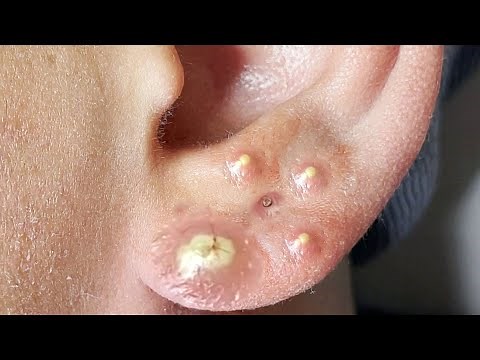 Suri Job #624: Awesome Blackheads And Whiteheads Extraction