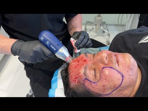 ROHRER-ING ACNE SCAR RESULTS WITH PIXEL 8 RF BY ROHRER | Dr. Jason Emer