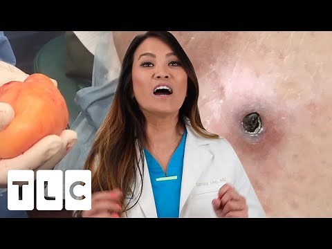 Dr Lee's Most Epic Pop & The Giant Blackhead Under The Skin | Dr. Pimple Popper: This Is Zit