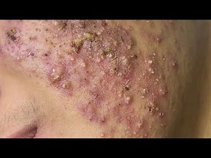 Blackhead removal with NaSa Spa | Satisfying and Relaxation Acne Treatment with NaSa Spa #103