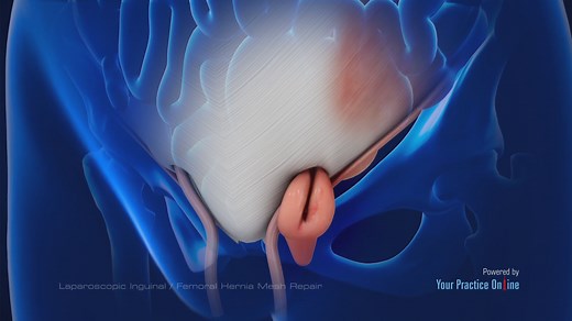Laparoscopic Inguinal or Femoral Hernia Mesh Repair