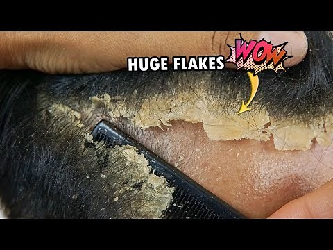 Dandruff Huge Flakes Scratching Satisfying #631