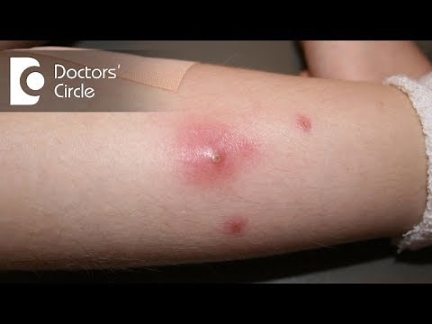 Diagnosis and management of boil on buttock area - Dr. Rasya Dixit