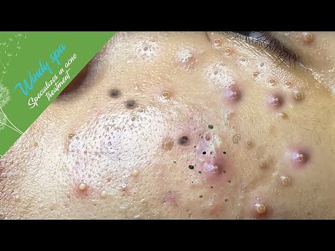(Acne Treatment for Huy Part 4) - Make Your Day Relaxing with Windy Spa 6#208