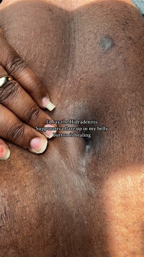 Destineé Spruell | I don’t post scars for attention. I post them so someone out there knows they’re not alone in this nightmare of invisible pain.... | Instagram