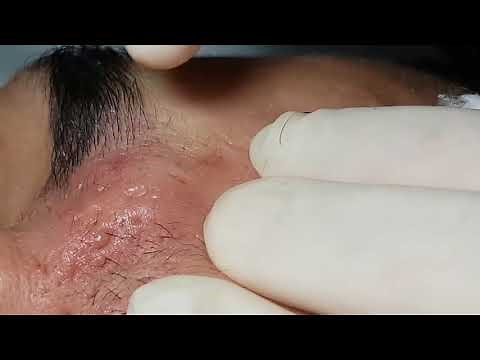 Severe Cystic Acne - Victor: Electrolysis Between Eyebrows