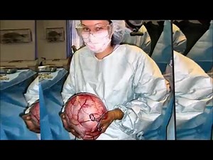 Giant Ovarian Cyst Removed & Popped