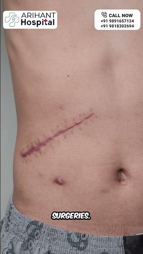 Surgical Incisions Explained: A Quick Guide for Every Procedure