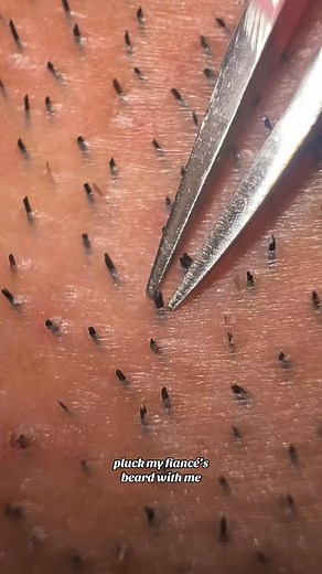 starting the week off right, with some beard pulling 🤗 #beard #plucking #satisfyingvideo #trichotillomania #satisfying #tweezing #fypage #skinpicking #thick #ingrown | PickyNiki