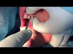 Canine Extraction
